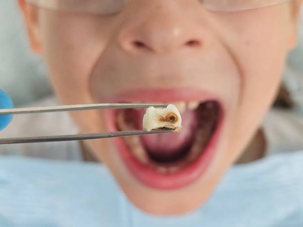 Best Emergency Treatment for Toothache in Chariton, IA